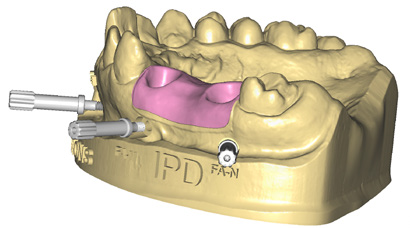 http://www.proteticke-komponenty.cz/images/3d_tisteny_model_digitalni_analogy.jpg