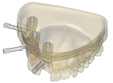 http://www.proteticke-komponenty.cz/images/digitalni_analogy_3d_model.jpg