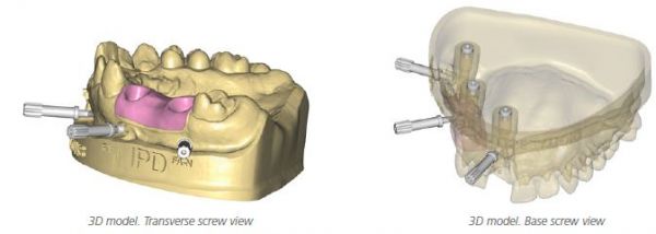 http://www.proteticke-komponenty.cz/images/digitalni_analogy_zubni_implantaty.jpg