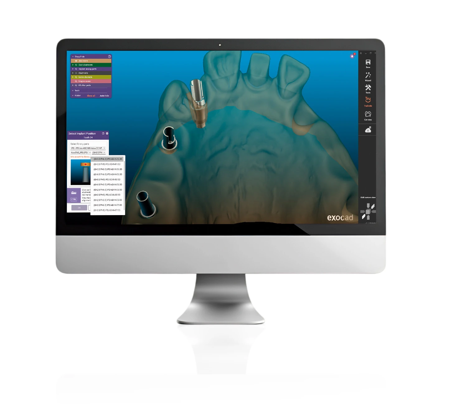Example of implant-position detection in an exocad workflow using an IPD library
