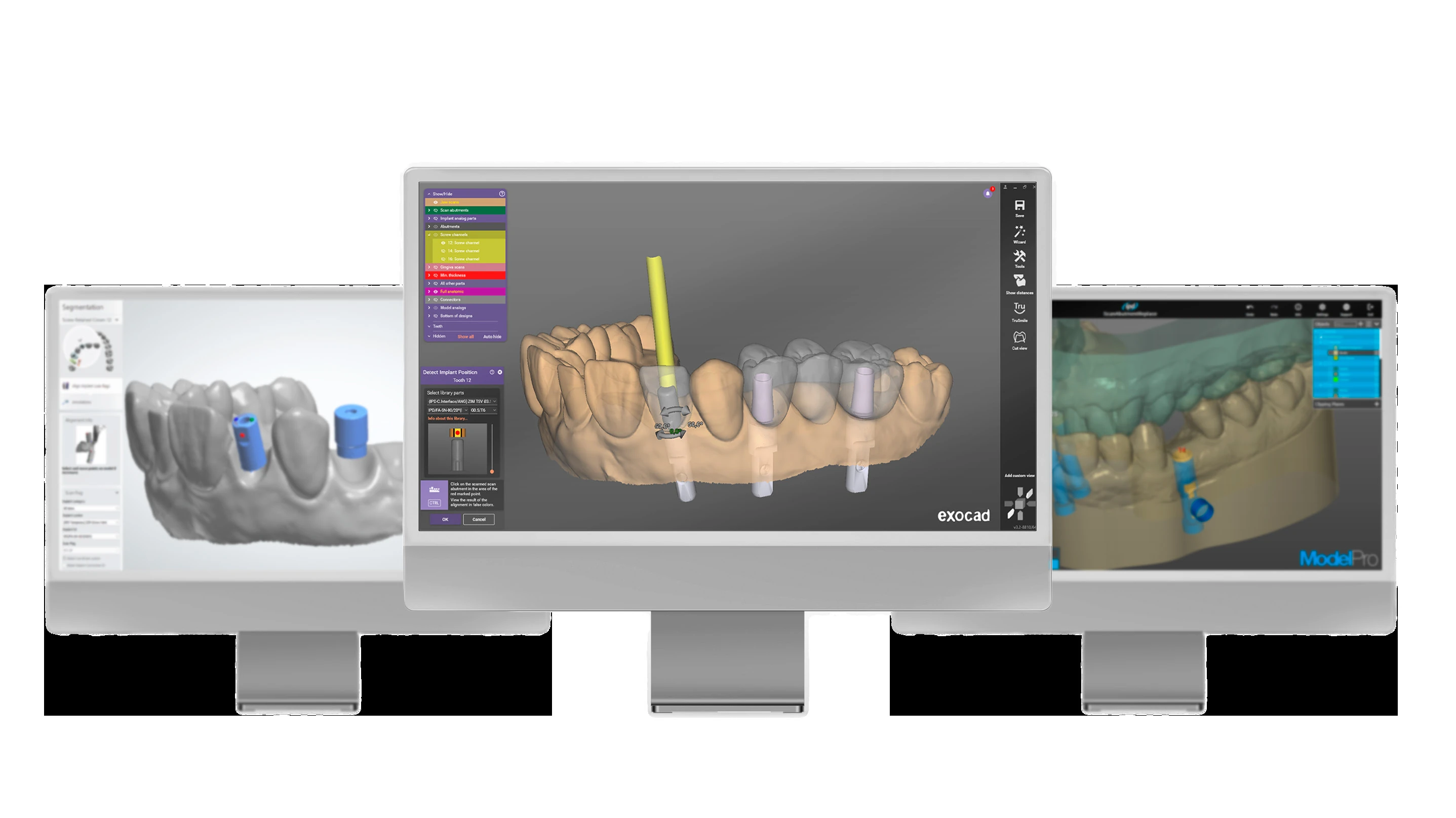 IPD CAD libraries for exocad, ModelPro and other CAD/CAM environments
