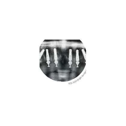 Plánování implantace