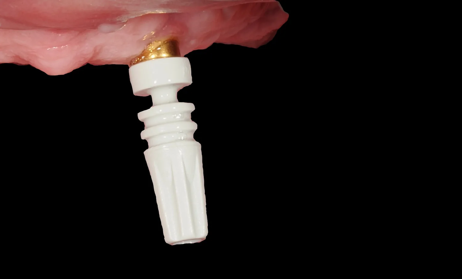 KA-CL-14 on PSD attachments as a digital transfer for a hybrid prosthesis