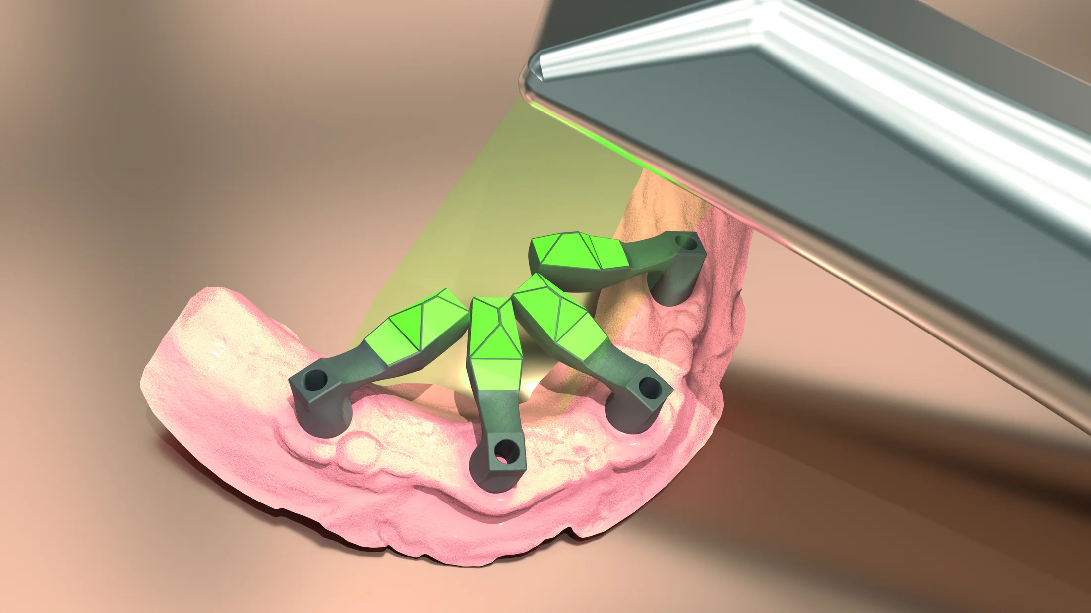 Digital full-arch scanning using Scan Flag iQ and an intraoral scanner
