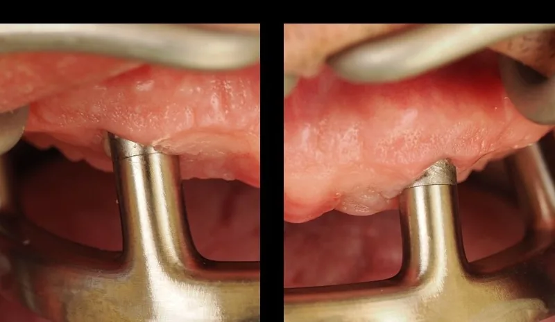 One-screw passive-fit check of a full-arch restoration – Sheffield test