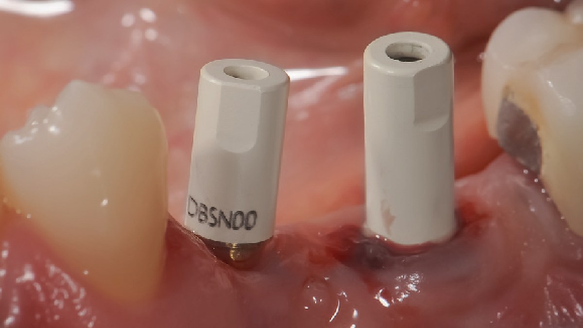 Different implant connections in one case
