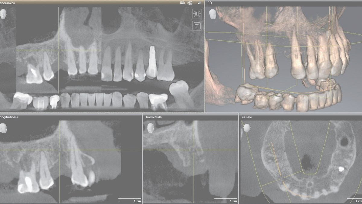 Implant prosthodontics from CBCT to crown