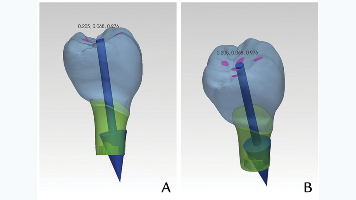 Vector analysis of an implant-prosthetic restoration from the original PDF