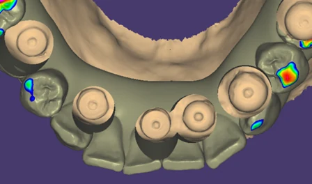 Digital map of reference surfaces during implant scanning