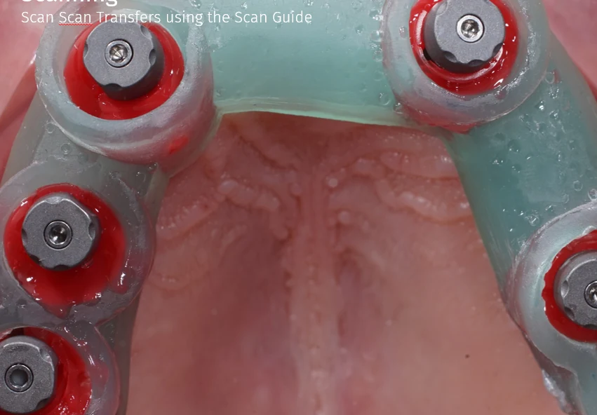 Scan Transfer in an intraoral scanning template